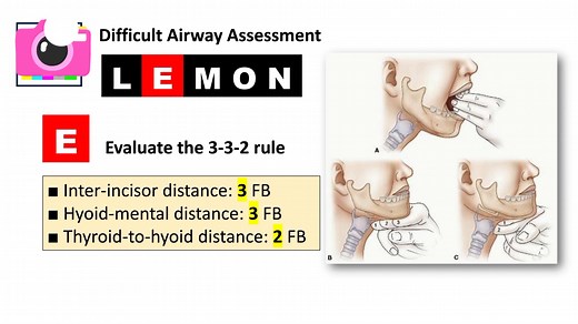 Lemon Criteria for Difficult Airway Assessment | Khalid's Clinical Anaesthesia