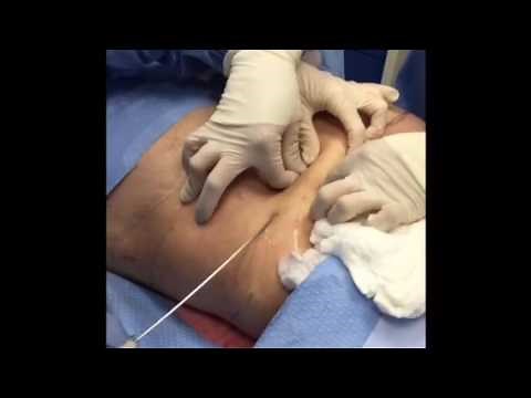 Tumescent Liposuction for Fat Removal