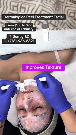 📍Surrey, BC ☎️For appointments call/text (778)986-8821 #surreysalon #fyp #hydrafacial #microneedling #nanoinfusion