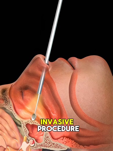 Brain Surgery Without Big Cuts: Endoscopic Technique Explained