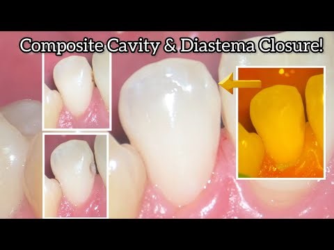 Anterior Tooth Cavity & Diastema Closure with Composite Step by Step