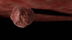 Growth of cancer cells. Tumor cells growing over tissue.
