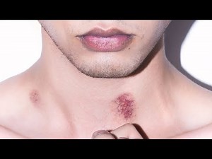 fast and easy way to give someone a hickey at home