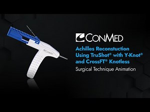 Achilles Reconstruction Using TruShot® and CrossFT® Knotless - CONMED Animation