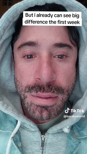 Laser Depigmentation: Changing Eye Color from Green to Light Blue