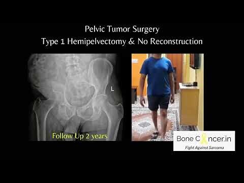 Treatment for Bone Cancer (Chondrosarcoma): Pelvic Tumour Surgery-Hemipelvectomy, Dr Srimanth B S