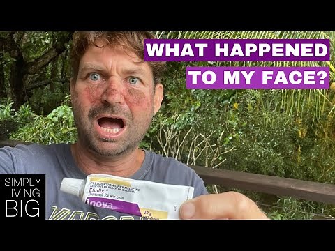 Using efudix cream on your face, my tips and experience.