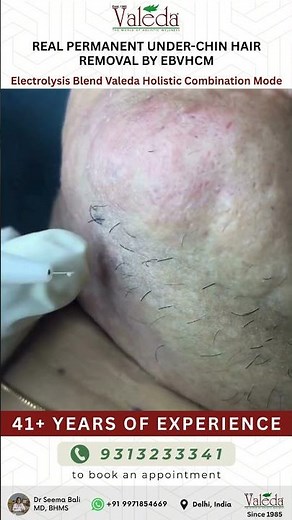 Real Permanent Under-Chin Hair Removal by EBVHCM