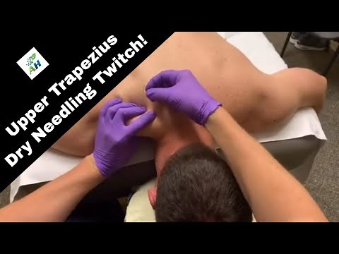 Upper Trapezius Dry Needling Twitch | Trapezius Pain Relief!