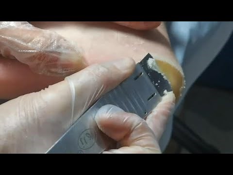 Pedicure 1-2 : Dead skin removal and Cracked heels treatment. Callus removal from feet.