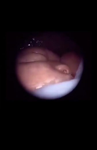 La fetoscopia endoscópica es un procedimiento quirúrgico durante el embarazo para visualizar al feto