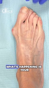 Fixing Bunions? Why the Akin osteotomy is a MUST!! #minimallyinvasivesurgery #misbunion #arthrex #footsurgeon #surgicaltechnique #podiatricsurgery #bunionectomy #orthosurgery #surgicaleducation #footspecialist #campitellitechnique | Dr. Nicholas A Campitelli - Podiatric Medicine and Surgery