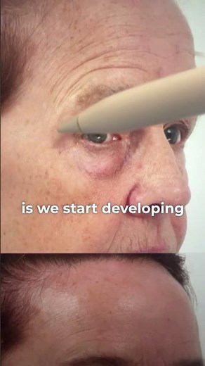 Brow lift and Eyelid Surgery Transformation