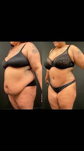 Dr. Remus Repta ⭐️⭐️⭐️⭐️⭐️ on Instagram: "✨ Tummy Tuck Transformation ✨ Watch this incredible journey of transformation with Dr. Repta’s expertly performed a Plus Size Tummy Tuck®, also known as abdominoplasty. Our patient is now enjoying a flatter, more toned abdomen and renewed confidence! No BMI requirements – because every body deserves to feel amazing. 💪 Dr. Repta specializes in creating tailored procedures that bring out the best in each patient. Ready to start your own transformation jou