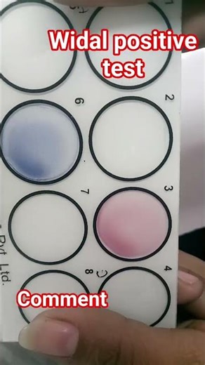 Widal Test positive 🩸👩‍⚕️🩸👩‍⚕️🩸seen agglutination 📸⚡💥👈