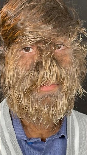 World's HAIRIEST man 😮