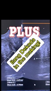 Yes, an endometrioma, (cyst sa obaryo) containing endometrial like tissue, can indeed cause dilated renal calyces, a condition known as hydronephrosis. This happens when the endometriosis, or even just its presence, obstructs the ureter, the tube that carries urine from the kidney to the bladder. The obstruction leads to urine backup, causing the calyces (the cup-like projections that collect urine in the kidney) and renal pelvis to dilate. #ObGynLife #ObGynUltrasound #PelvicEndometriosis #Endom