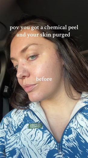 Understanding Chemical Peel Skin Purging Process