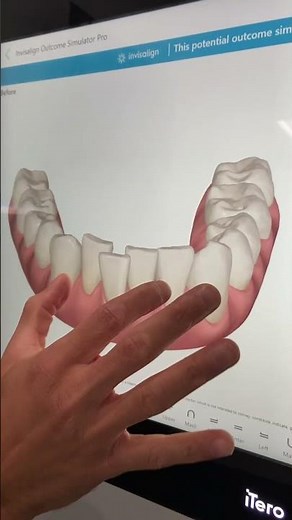 Invisalign Consultation for Busy Professional: Before and After Digital Scan Smile Simulation