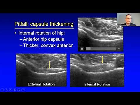 Dr. Jon Jacobson talks about US of Hip Pathology