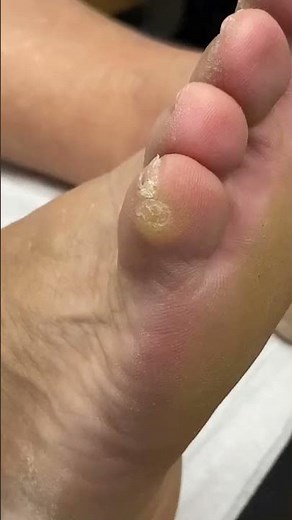 Painful Corn Removal on Little Toe by Australian Podiatrist |Effective Solutions for Callus & Corns