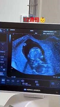 【妊娠12週目】赤ちゃんのエコー動画①👶順調に育ってるみたい🤗少し動いてます🥺#赤ちゃん#胎児#エコー#妊娠12週目#病院 #関西 #baby #性別