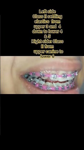 Left side:Class II settling elastics from upper 3 & 4 down to lower 4 & 5 .On Right side: Class II
