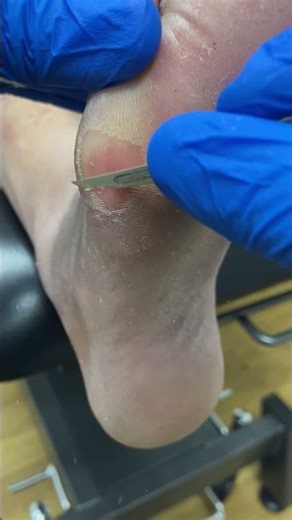 Satisfying Callus Removal by Podiatrist #CallusCutting #FootCare #SatisfyingVideos