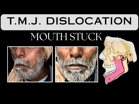 TMJ DISLOCATION AND CORRECTION