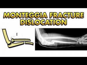 Monteggia Fracture Dislocation: Bado Classification, Treatment and Complications