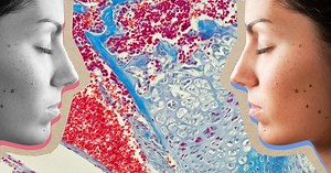 Cancers de la peau : les signes qui doivent alerter