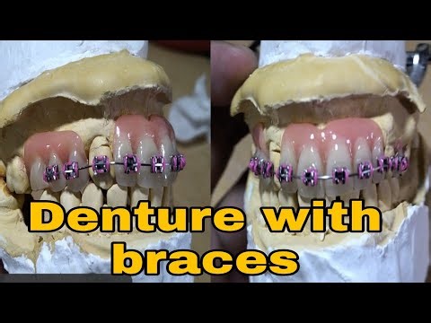 Denture with braces, Pustiso with braces, Retainer like braces.