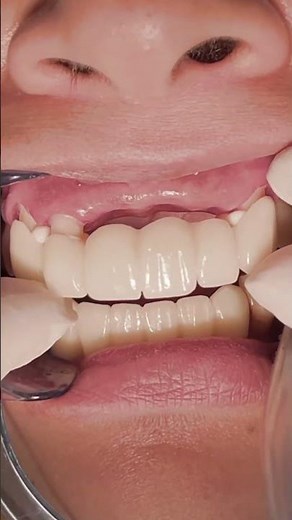 Zirconium bridge to replace missing upper anterior teeth 🦷