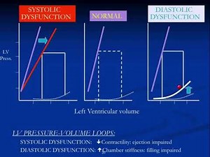 【心不全】話題のHFpEF(ヘフペプ)って知ってる？なぜなる？どう治療する？最新の知見を詳しく解説
