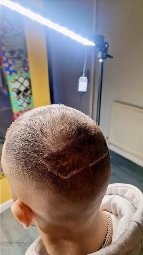 SMP hair tattoo realism restores confidence bold clean hairline ink transformation #Tattoo #SMP UK!!