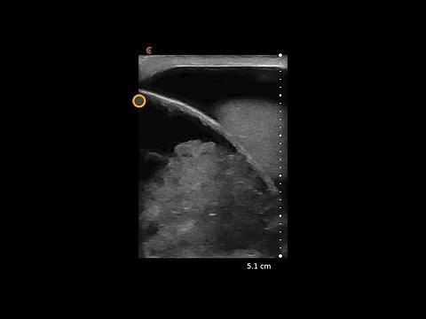 Incarcerated Hernia – Ultrasound Image Interpretation