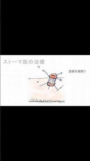 【ストーマ脱】これ大丈夫？原因と対策を1分で解説！#Shorts 012
