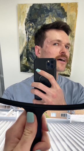 Acne Scar Surgery Results Revealed