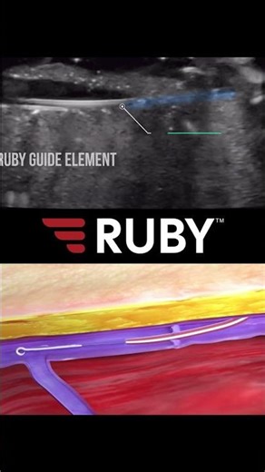 Ruby soft-tip guide element AST Peripheral IV catheter is finally here! #nurse #docto...