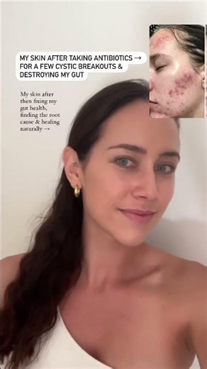 Why do antibiotics cause your acne to come back worse after stopping? Let’s break it down ↓ And don