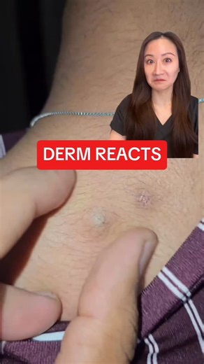 Jenny Liu, MD FAAD , Skincare Derm on Instagram: "One of the most common things I excise from skin. Don’t manipulate it, only makes it worse. Excision is the only way to get rid of them. Have you had an EIC before? #cystremoval #pimplepopping #dermatologist #skincaretipsandtricks"