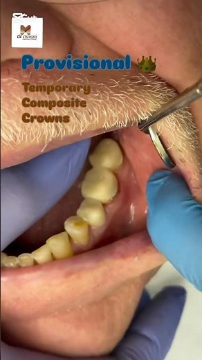 ✨Temporary Crown – your tooth’s short-term shield! 🦷👑