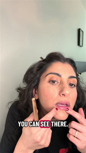 Cómo obtuve una cicatriz en el labio que todos confunden