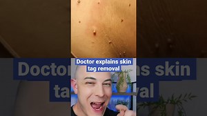 Interesting Skin Tag Removal Technique Explained