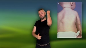 FOP disease means that people turns into human statue. Their muscle turns into stone. | The AyKa Show