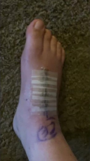 Day 20 after midfoot fusion & bone graft for lisfranc dislocation