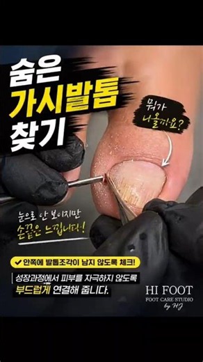 숨은 가시발톱 찾기 ! 내성발톱 통증원인 찾아서 해결🩷파고드는발톱케어 전문 하이풋 by 황원장 #footcare #ingrowingnail #pedicure #내성발톱#하이풋