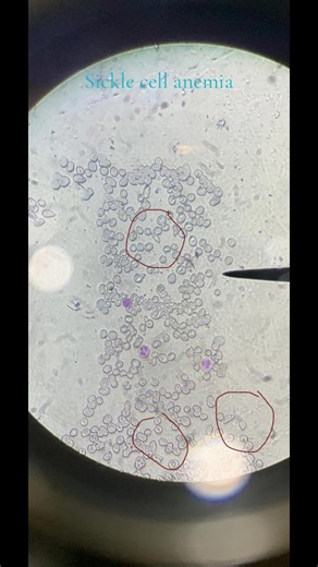 Understanding Sickle Cell Anemia: Causes and Effects