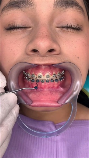 🔥Removing Chains and Colored Elastics at the Orthodontic Appointment📅