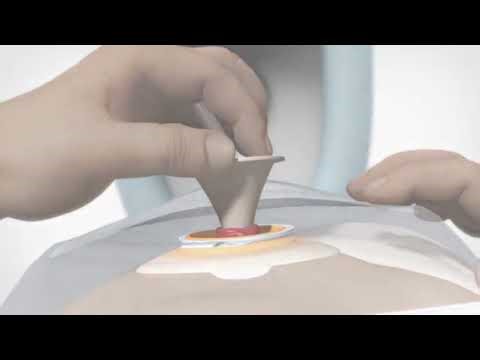 Assura® Irrigations-Set - Anleitungsvideo